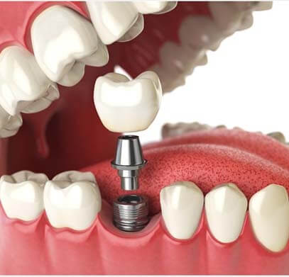 Dental Implants in Gurgaon